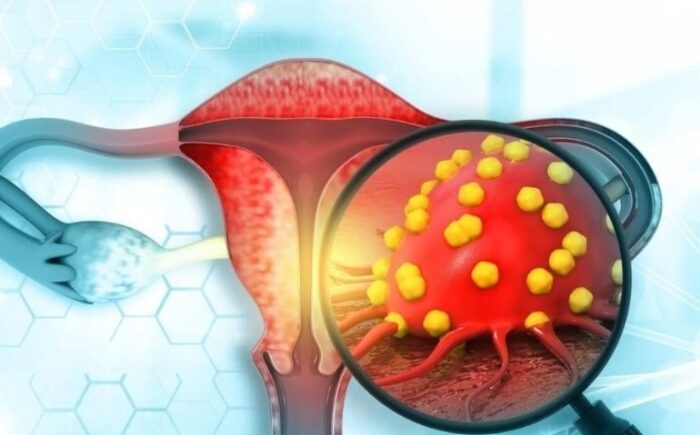 Endometrium Kanseri Sessiz İlerliyor: Uzmanından Kritik Uyarılar
